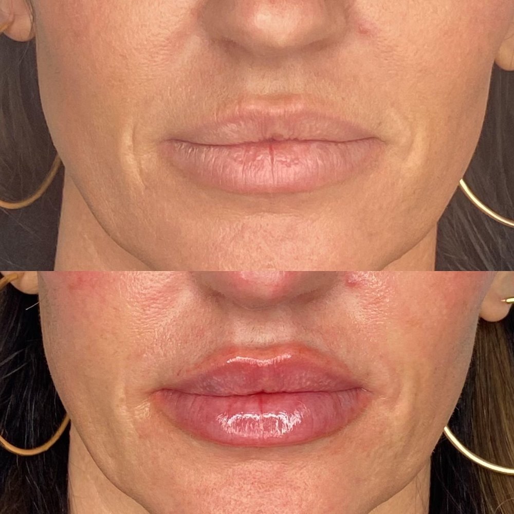 Lip filler before and after at eight 01 Aesthetics in Sandy, Utah