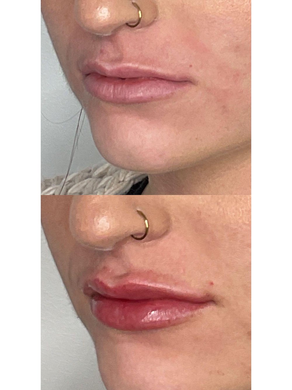 Lip filler before and after, side profile, at eight 01 Aesthetics in Sandy, Utah